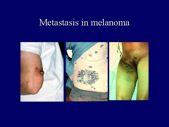 Metastasis in melanoma 