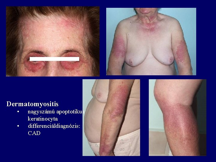 Dermatomyositis • • nagyszámú apoptotikus keratinocyta differenciáldiagnózis: CAD 