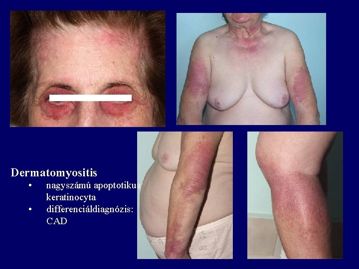 Dermatomyositis • • nagyszámú apoptotikus keratinocyta differenciáldiagnózis: CAD Dermatomyositis • • nagyszámú apoptotikus keratinocyta differenciáldiagnózis: CAD
