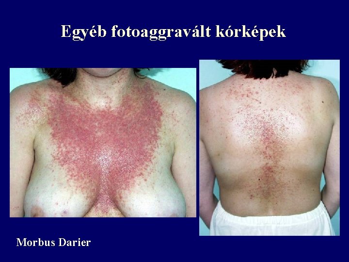 Egyéb fotoaggravált kórképek Morbus Darier Egyéb fotoaggravált kórképek Morbus Darier