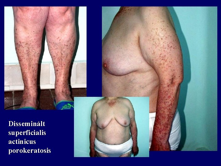 Disseminált superficialis actinicus porokeratosis 