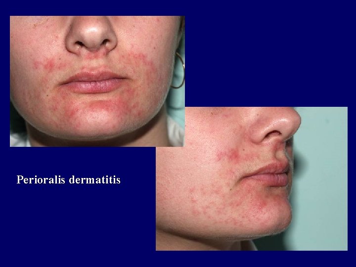 Perioralis dermatitis Perioralis dermatitis