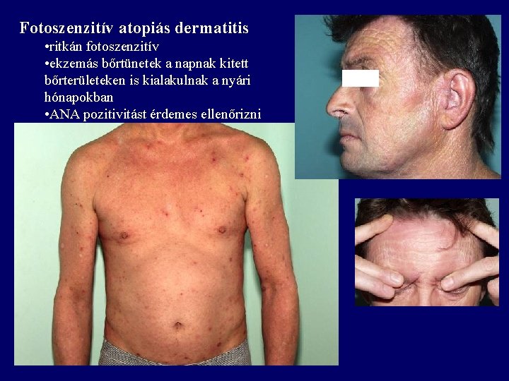 Fotoszenzitív atopiás dermatitis • ritkán fotoszenzitív • ekzemás bőrtünetek a napnak kitett bőrterületeken is