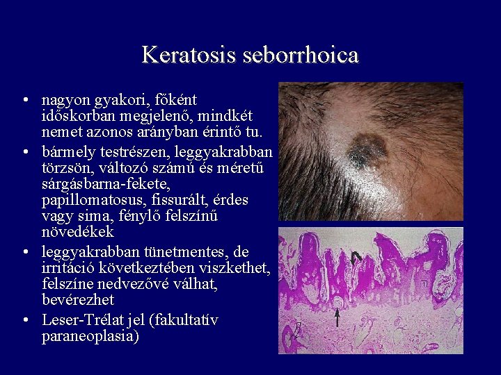 Keratosis seborrhoica • nagyon gyakori, főként időskorban megjelenő, mindkét nemet azonos arányban érintő tu. Keratosis seborrhoica • nagyon gyakori, főként időskorban megjelenő, mindkét nemet azonos arányban érintő tu.