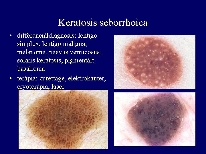 Keratosis seborrhoica • differenciáldiagnosis: lentigo simplex, lentigo maligna, melanoma, naevus verrucosus, solaris keratosis, pigmentált