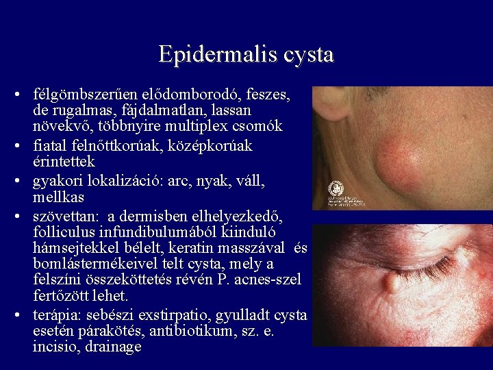 Epidermalis cysta • félgömbszerűen elődomborodó, feszes, de rugalmas, fájdalmatlan, lassan növekvő, többnyire multiplex csomók Epidermalis cysta • félgömbszerűen elődomborodó, feszes, de rugalmas, fájdalmatlan, lassan növekvő, többnyire multiplex csomók