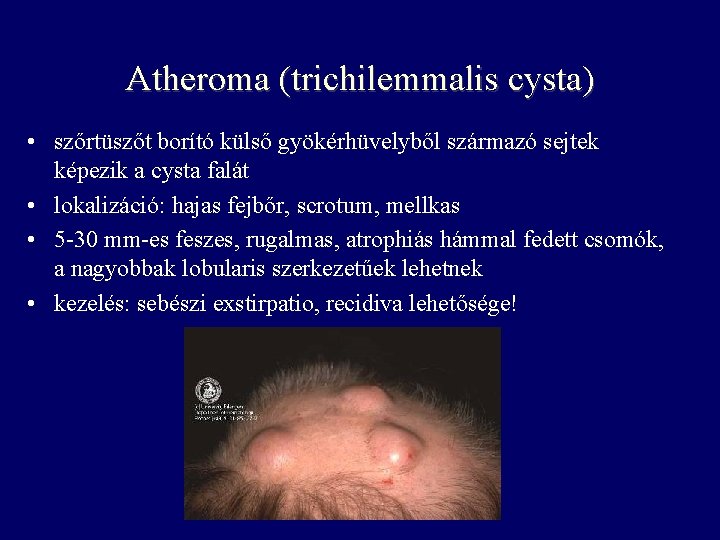 Atheroma (trichilemmalis cysta) • szőrtüszőt borító külső gyökérhüvelyből származó sejtek képezik a cysta falát Atheroma (trichilemmalis cysta) • szőrtüszőt borító külső gyökérhüvelyből származó sejtek képezik a cysta falát