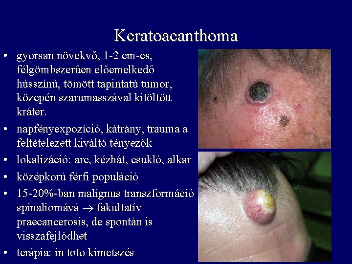 Keratoacanthoma • gyorsan növekvő, 1 -2 cm-es, félgömbszerűen előemelkedő hússzínű, tömött tapintatú tumor, közepén