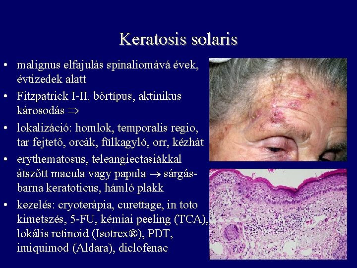 Keratosis solaris • malignus elfajulás spinaliomává évek, évtizedek alatt • Fitzpatrick I-II. bőrtípus, aktinikus