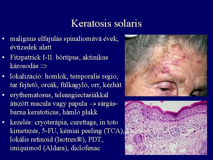 Keratosis solaris • malignus elfajulás spinaliomává évek, évtizedek alatt • Fitzpatrick I-II. bőrtípus, aktinikus Keratosis solaris • malignus elfajulás spinaliomává évek, évtizedek alatt • Fitzpatrick I-II. bőrtípus, aktinikus
