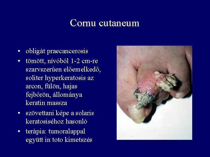 Cornu cutaneum • obligát praecancerosis • tömött, nívóból 1 -2 cm-re szarvszerűen előemelkedő, soliter