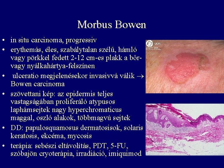 Morbus Bowen • in situ carcinoma, progressiv • erythemás, éles, szabálytalan szélű, hámló vagy Morbus Bowen • in situ carcinoma, progressiv • erythemás, éles, szabálytalan szélű, hámló vagy