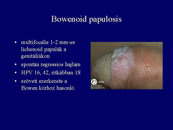 Bowenoid papulosis • multifocalis 1 -2 mm-es lichenoid papulák a genitáliákon • spontán regressios Bowenoid papulosis • multifocalis 1 -2 mm-es lichenoid papulák a genitáliákon • spontán regressios