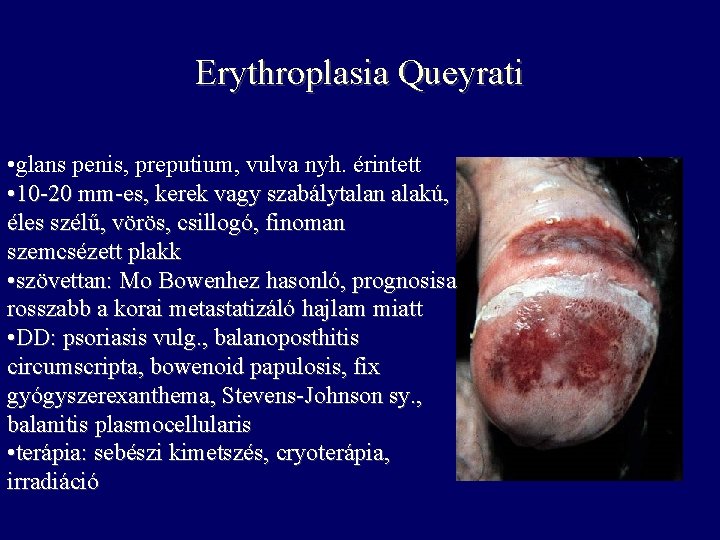 Erythroplasia Queyrati • glans penis, preputium, vulva nyh. érintett • 10 -20 mm-es, kerek