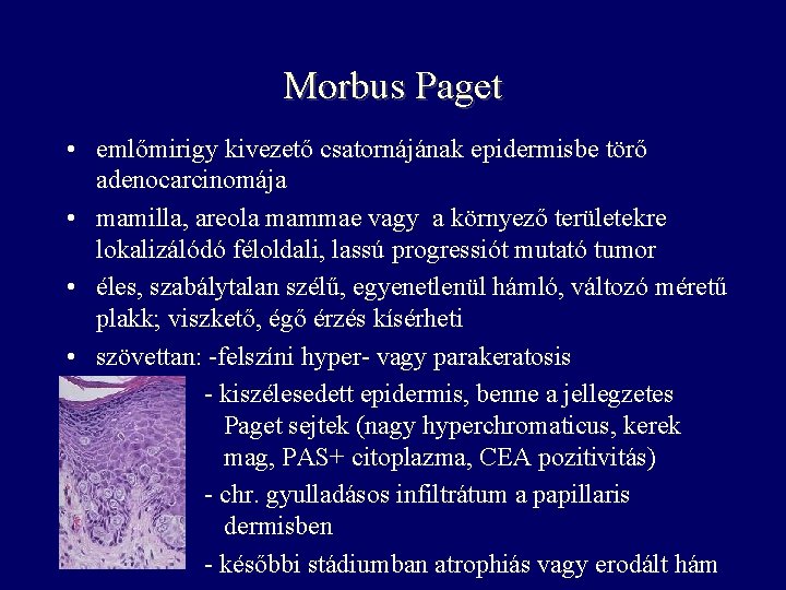 Morbus Paget • emlőmirigy kivezető csatornájának epidermisbe törő adenocarcinomája • mamilla, areola mammae vagy Morbus Paget • emlőmirigy kivezető csatornájának epidermisbe törő adenocarcinomája • mamilla, areola mammae vagy