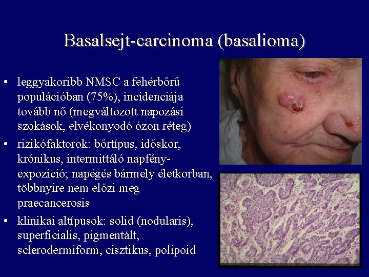 Basalsejt-carcinoma (basalioma) • leggyakoribb NMSC a fehérbőrű populációban (75%), incidenciája tovább nő (megváltozott napozási