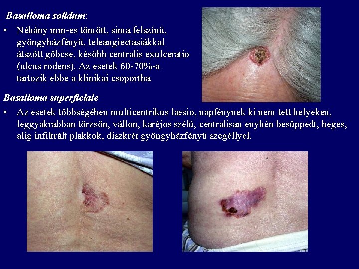 Basalioma solidum: • Néhány mm-es tömött, sima felszínű, gyöngyházfényű, teleangiectasiákkal átszőtt göbcse, később centralis Basalioma solidum: • Néhány mm-es tömött, sima felszínű, gyöngyházfényű, teleangiectasiákkal átszőtt göbcse, később centralis