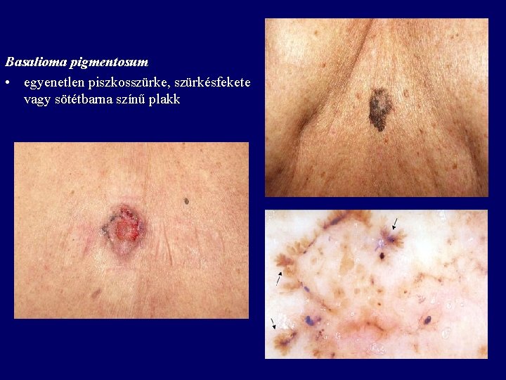 Basalioma pigmentosum • egyenetlen piszkosszürke, szürkésfekete vagy sötétbarna színű plakk Basalioma pigmentosum • egyenetlen piszkosszürke, szürkésfekete vagy sötétbarna színű plakk
