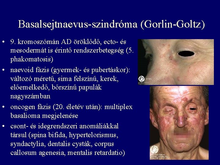 Basalsejtnaevus-szindróma (Gorlin-Goltz) • 9. kromoszómán AD öröklődő, ecto- és mesodermát is érintő rendszerbetegség (5.
