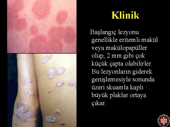 Klinik Başlangıç lezyonu genellikle eritemli makül veya makülopapüller olup, 2 mm gibi çok küçük