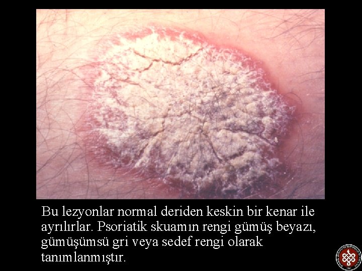  Bu lezyonlar normal deriden keskin bir kenar ile ayrılırlar. Psoriatik skuamın rengi gümüş
