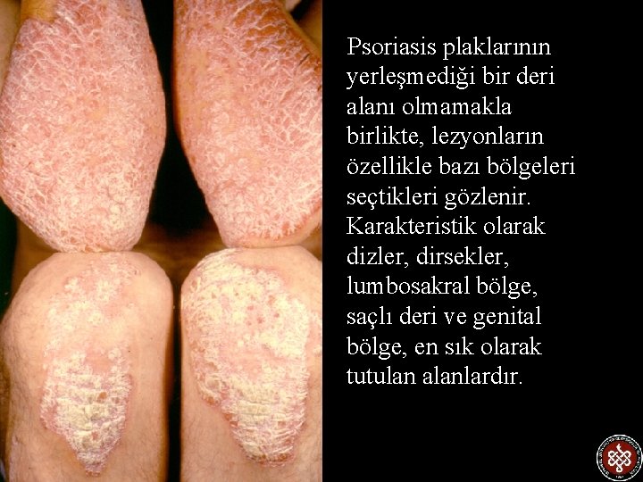  Psoriasis plaklarının yerleşmediği bir deri alanı olmamakla birlikte, lezyonların özellikle bazı bölgeleri seçtikleri