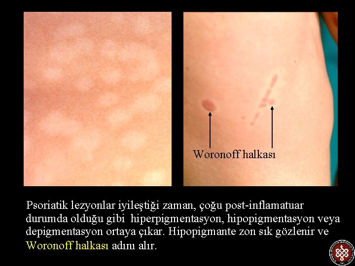 Woronoff halkası Psoriatik lezyonlar iyileştiği zaman, çoğu post-inflamatuar durumda olduğu gibi hiperpigmentasyon, hipopigmentasyon veya