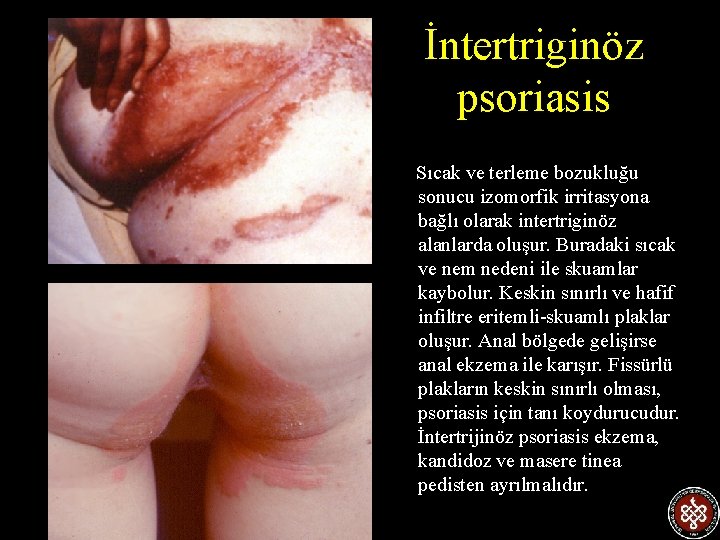 İntertriginöz psoriasis Sıcak ve terleme bozukluğu sonucu izomorfik irritasyona bağlı olarak intertriginöz alanlarda oluşur.