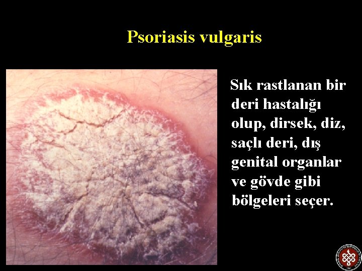 Psoriasis vulgaris Sık rastlanan bir deri hastalığı olup, dirsek, diz, saçlı deri, dış genital
