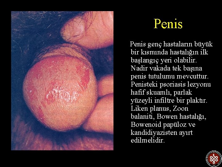 Penis genç hastaların büyük bir kısmında hastalığın ilk başlangıç yeri olabilir. Nadir vakada tek