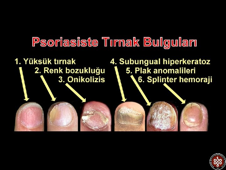 Tırnak Psoriasisi 