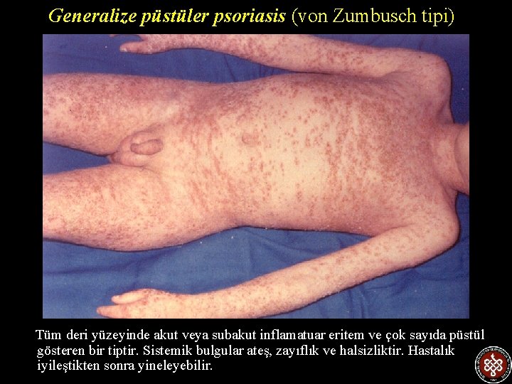 Generalize püstüler psoriasis (von Zumbusch tipi) Tüm deri yüzeyinde akut veya subakut inflamatuar eritem