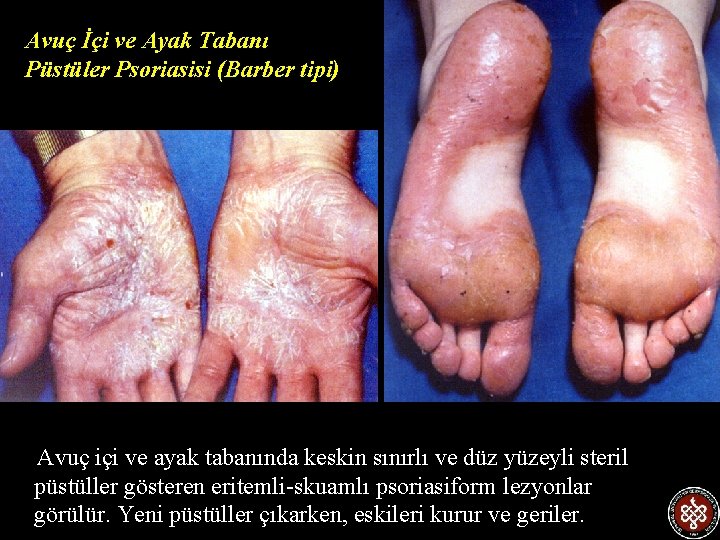 Avuç İçi ve Ayak Tabanı Püstüler Psoriasisi (Barber tipi) Avuç içi ve ayak tabanında