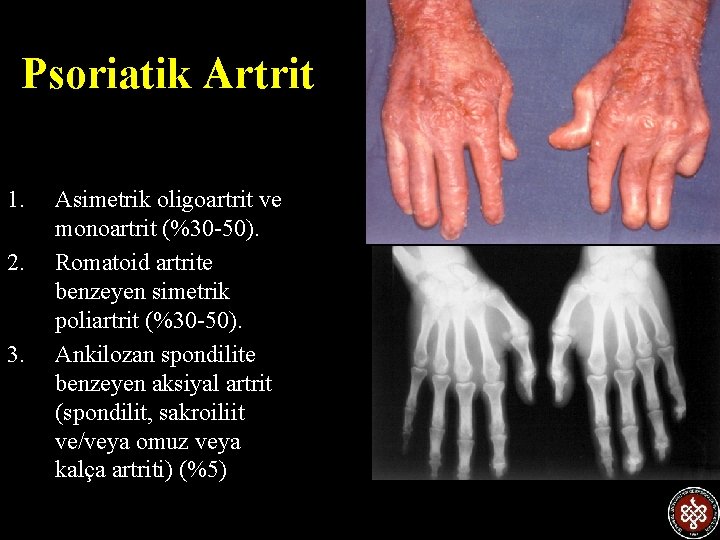 Psoriatik Artrit 1. 2. 3. Asimetrik oligoartrit ve monoartrit (%30 -50). Romatoid artrite benzeyen