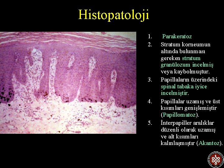 Histopatoloji 1. 2. 3. 4. 5. Parakeratoz Stratum korneumun altında bulunması gereken stratum granülozum