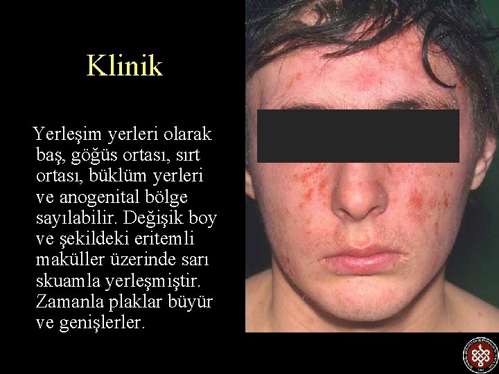 Klinik Yerleşim yerleri olarak baş, göğüs ortası, sırt ortası, büklüm yerleri ve anogenital bölge