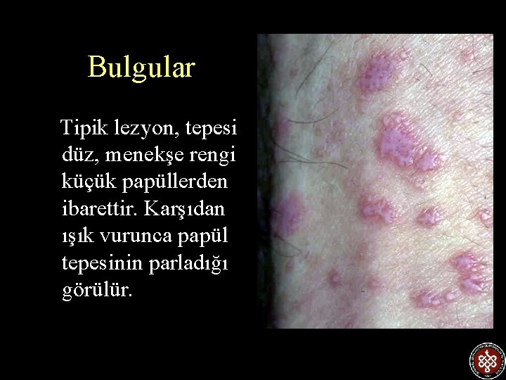 Bulgular Tipik lezyon, tepesi düz, menekşe rengi küçük papüllerden ibarettir. Karşıdan ışık vurunca papül