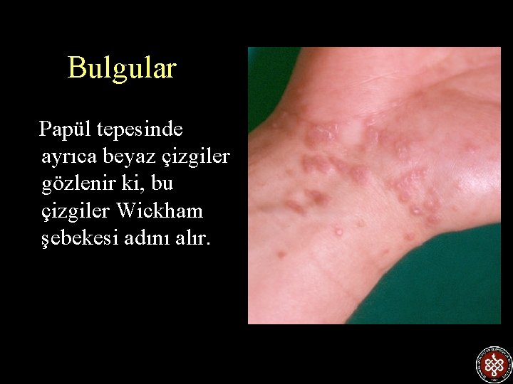 Bulgular Papül tepesinde ayrıca beyaz çizgiler gözlenir ki, bu çizgiler Wickham şebekesi adını alır.