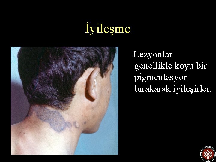 İyileşme Lezyonlar genellikle koyu bir pigmentasyon bırakarak iyileşirler. 