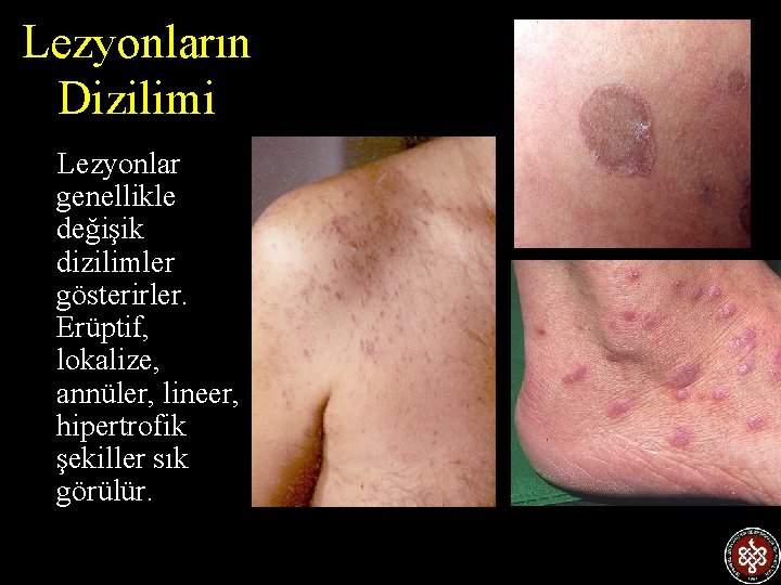 Lezyonların Dizilimi Lezyonlar genellikle değişik dizilimler gösterirler. Erüptif, lokalize, annüler, lineer, hipertrofik şekiller sık