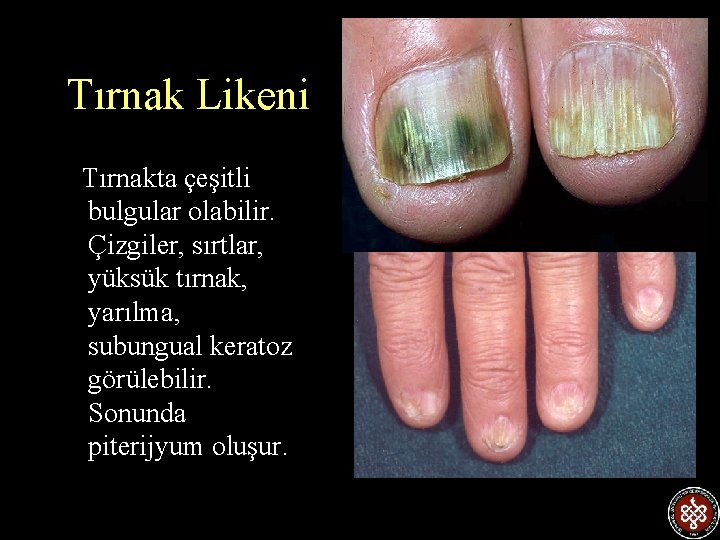 Tırnak Likeni Tırnakta çeşitli bulgular olabilir. Çizgiler, sırtlar, yüksük tırnak, yarılma, subungual keratoz görülebilir.