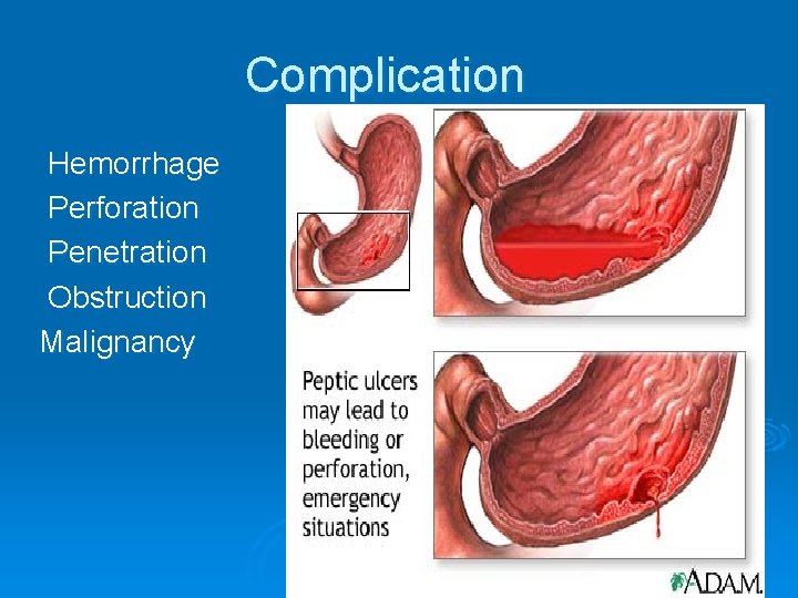 Complication Hemorrhage Perforation Penetration Obstruction Malignancy 