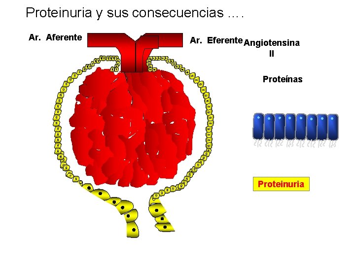 Proteinuria y sus consecuencias …. Ar. Aferente Ar. Eferente Angiotensina II Proteínas Proteinuria 