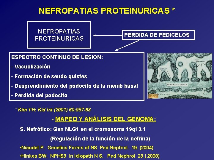 NEFROPATIAS PROTEINURICAS * NEFROPATIAS PROTEINURICAS PERDIDA DE PEDICELOS ESPECTRO CONTINUO DE LESION: - Vacuolización