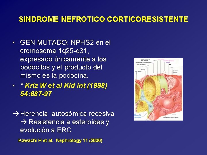 SINDROME NEFROTICO CORTICORESISTENTE • GEN MUTADO: NPHS 2 en el cromosoma 1 q 25