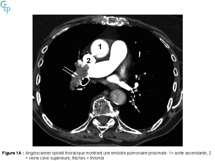 Figure 1 A : Angioscanner spiralé thoracique montrant une embolie pulmonaire proximale. 1= aorte