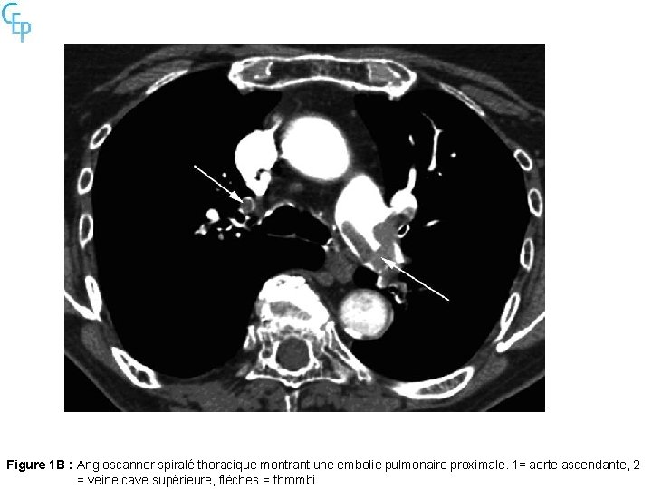 Figure 1 B : Angioscanner spiralé thoracique montrant une embolie pulmonaire proximale. 1= aorte