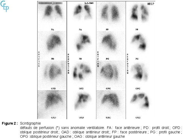 Figure 2 : Scintigraphie défauts de perfusion (*) sans anomalie ventilatoire. FA : face
