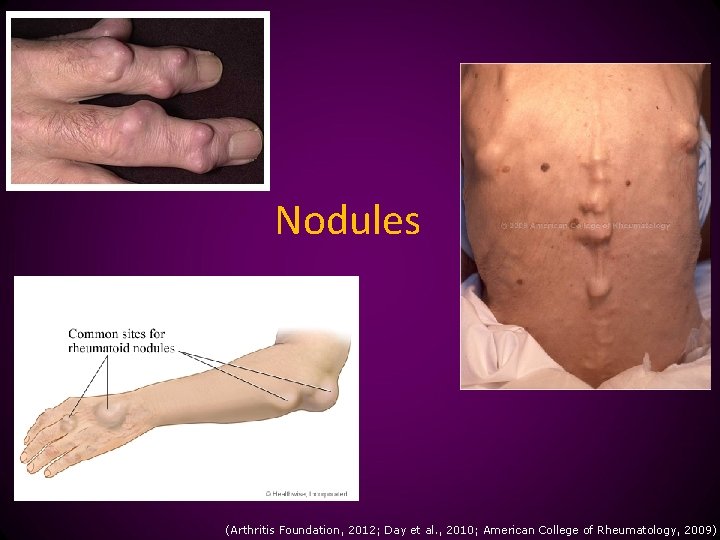 Nodules (Arthritis Foundation, 2012; Day et al. , 2010; American College of Rheumatology, 2009)