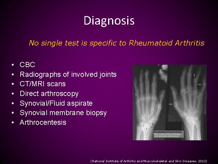 Diagnosis No single test is specific to Rheumatoid Arthritis • • CBC Radiographs of